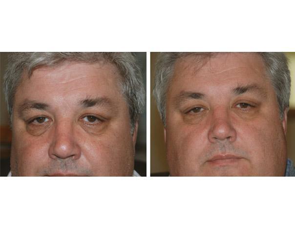 Facial fillers before and after photos cheek fillers under eye ...